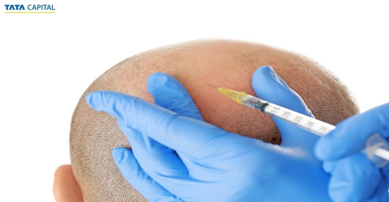 How A Personal Loan Can Help You in Financing Your Hair Transplant Surgery